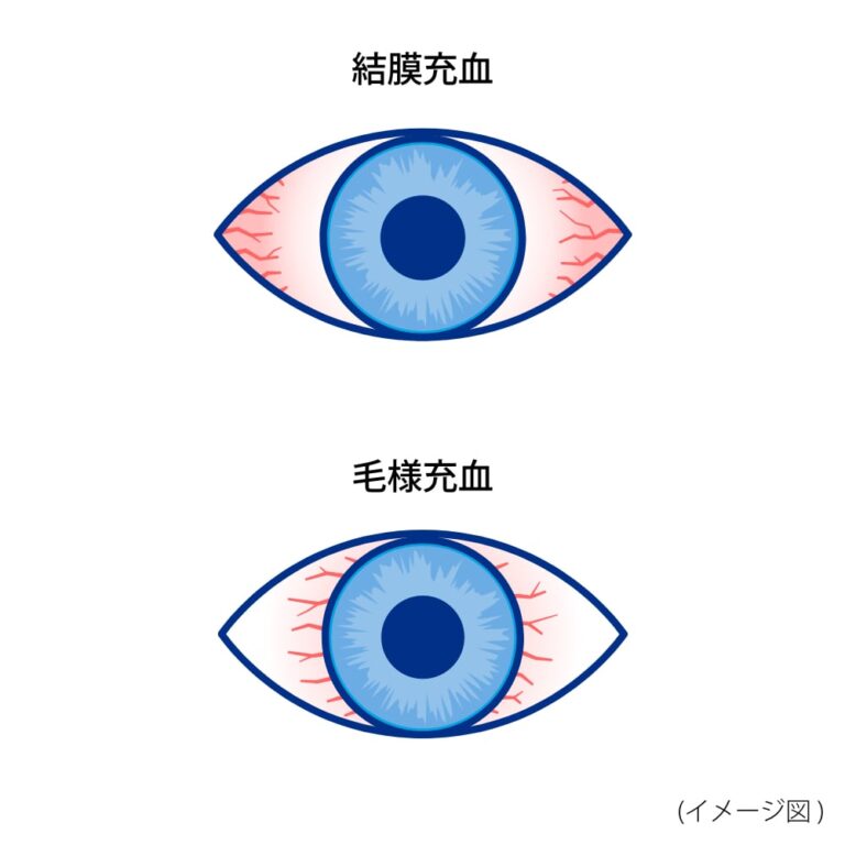 「目の充血」冷やす?温める?横須賀で改善したいあなたへ - 横須賀の整体-湘南山手整体院