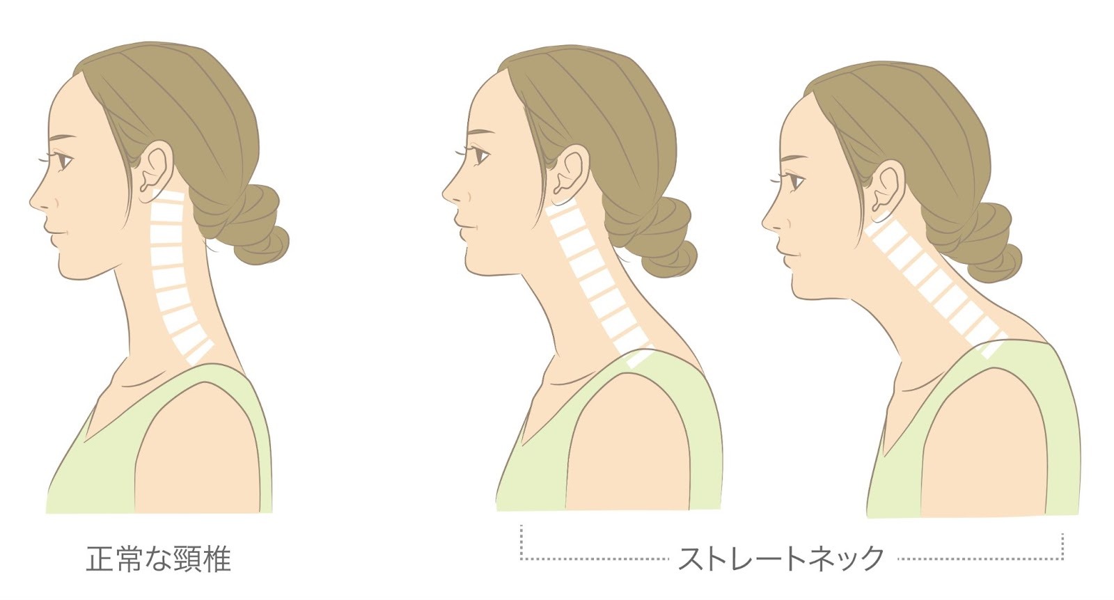 正常な首とストレートネックのイラストです。
