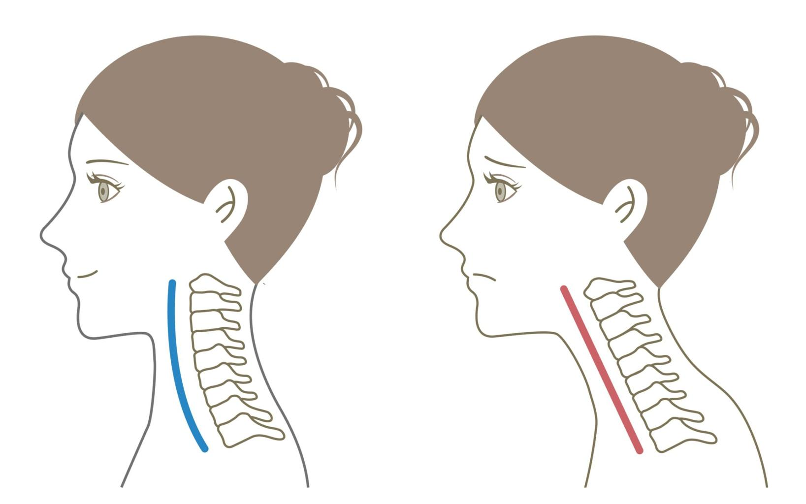 正常な首のカーブとストレートネックの違いイメージ