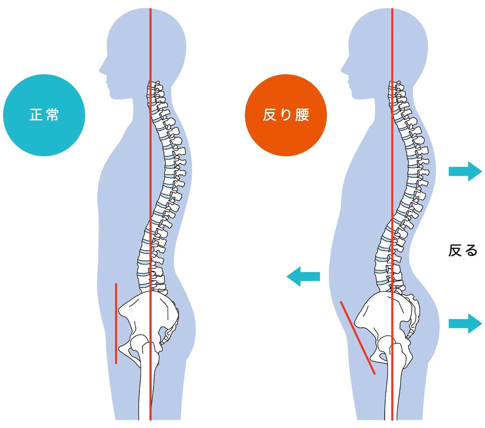 反り腰・正常な背骨のイラストです。