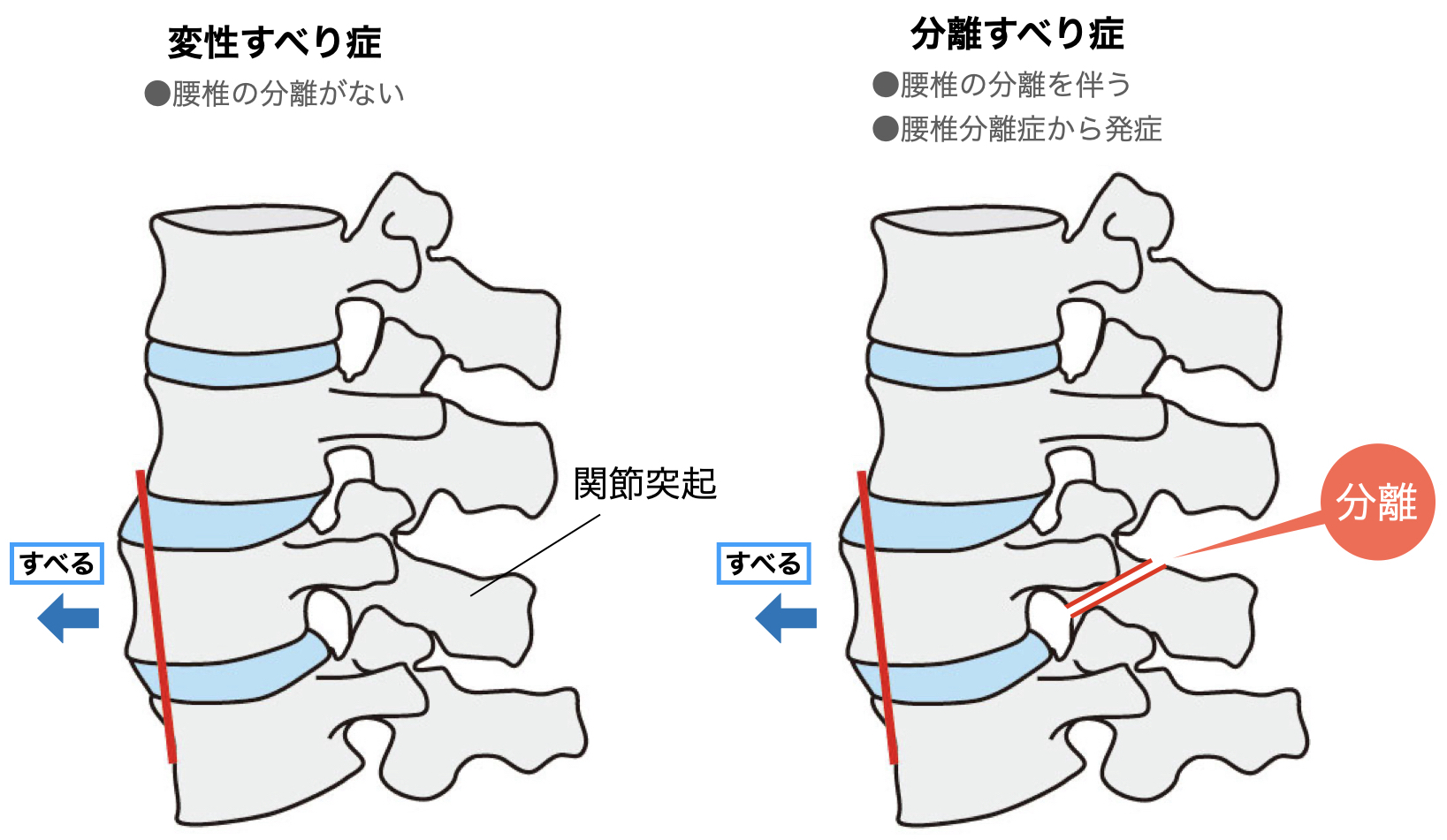 腰椎すべり症・分離症のイラストです。