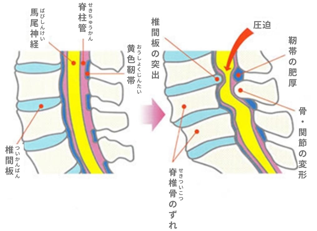 脊柱管が狭くなり、神経が圧迫されているイラストです。
