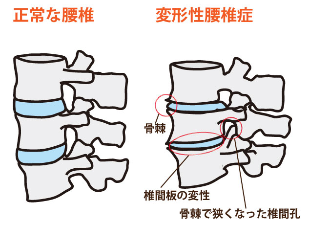 変形性腰椎症のイラストです。