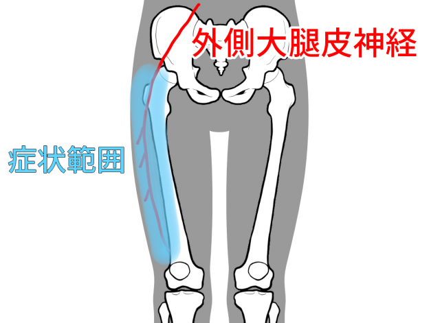 外側大腿皮神経の症状範囲を現したイラストです。