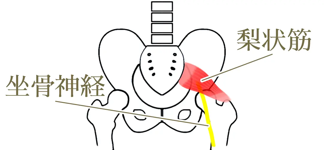 梨状筋症候群のイラストです。