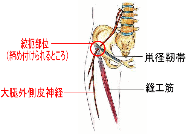 大腿外側皮神経が締め付けられているイラストです。