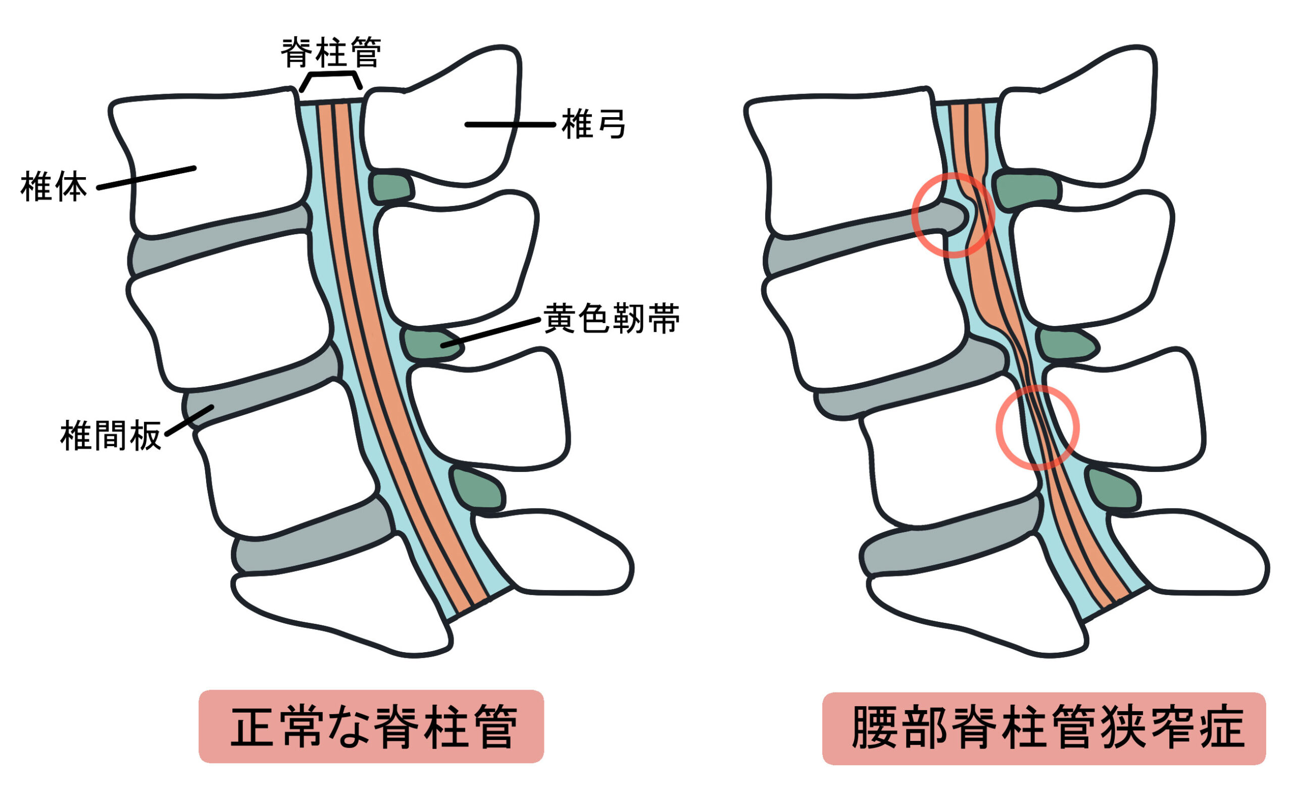 腰部脊柱管狭窄症のイラストです。